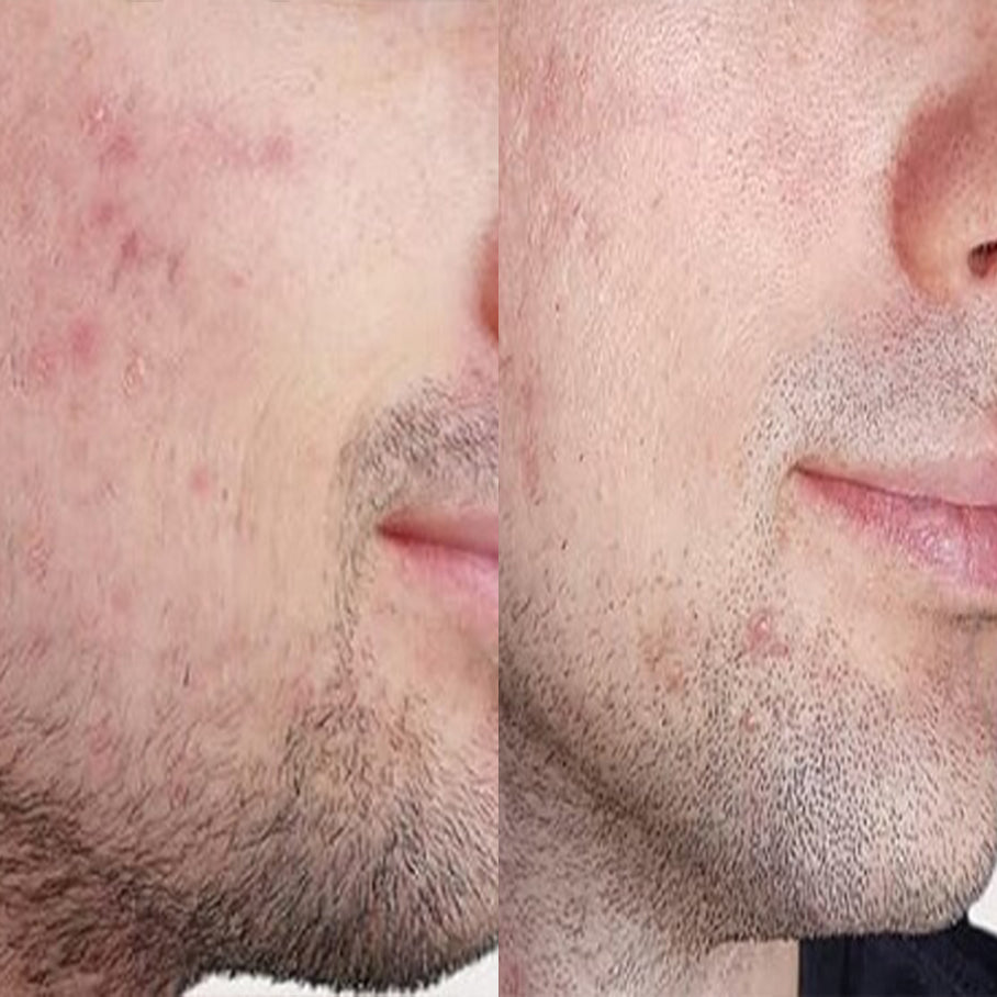 Flawless Skin Complete Kit